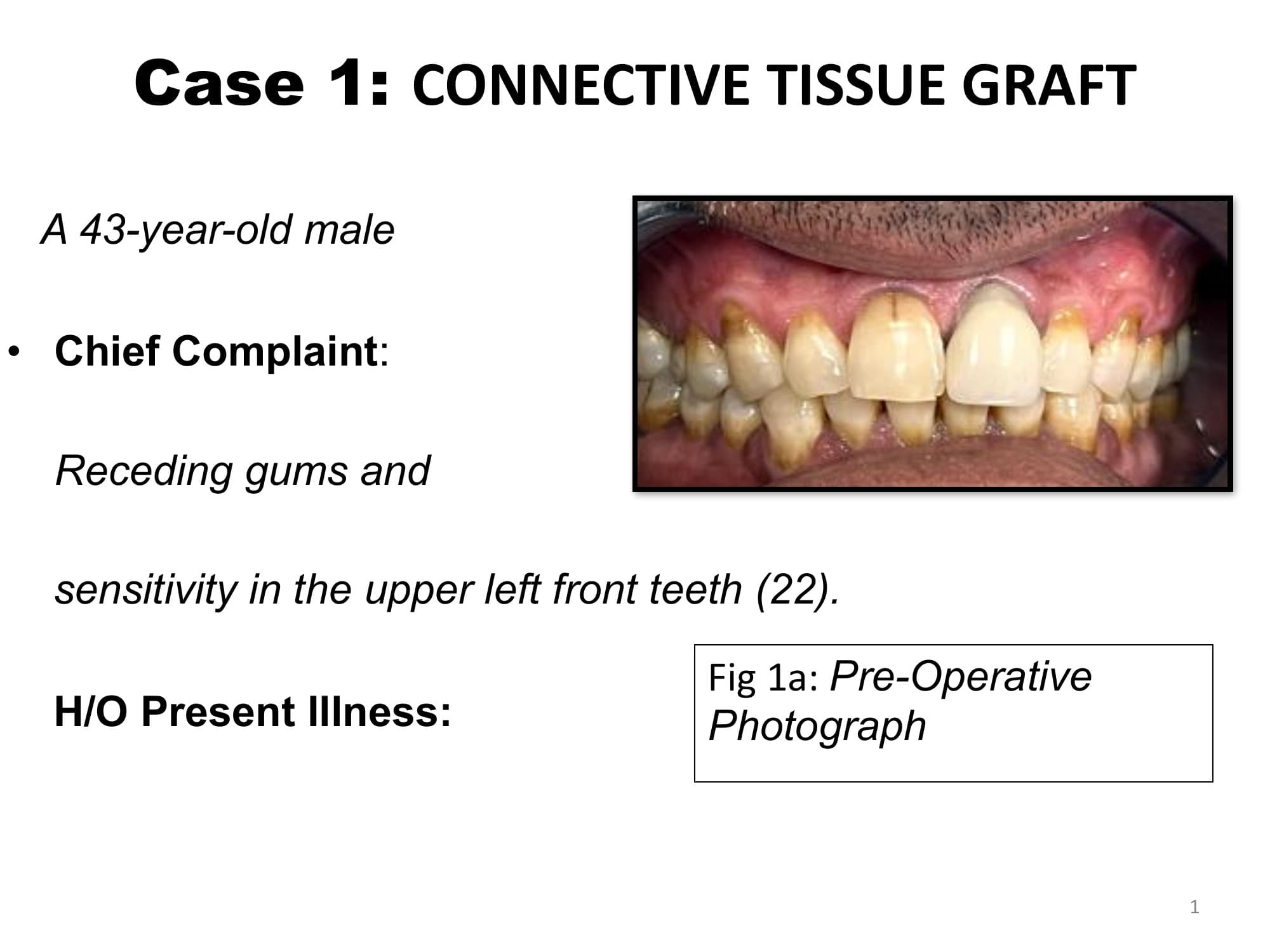 Connective tissue graft case - pre-operative and post-operative results