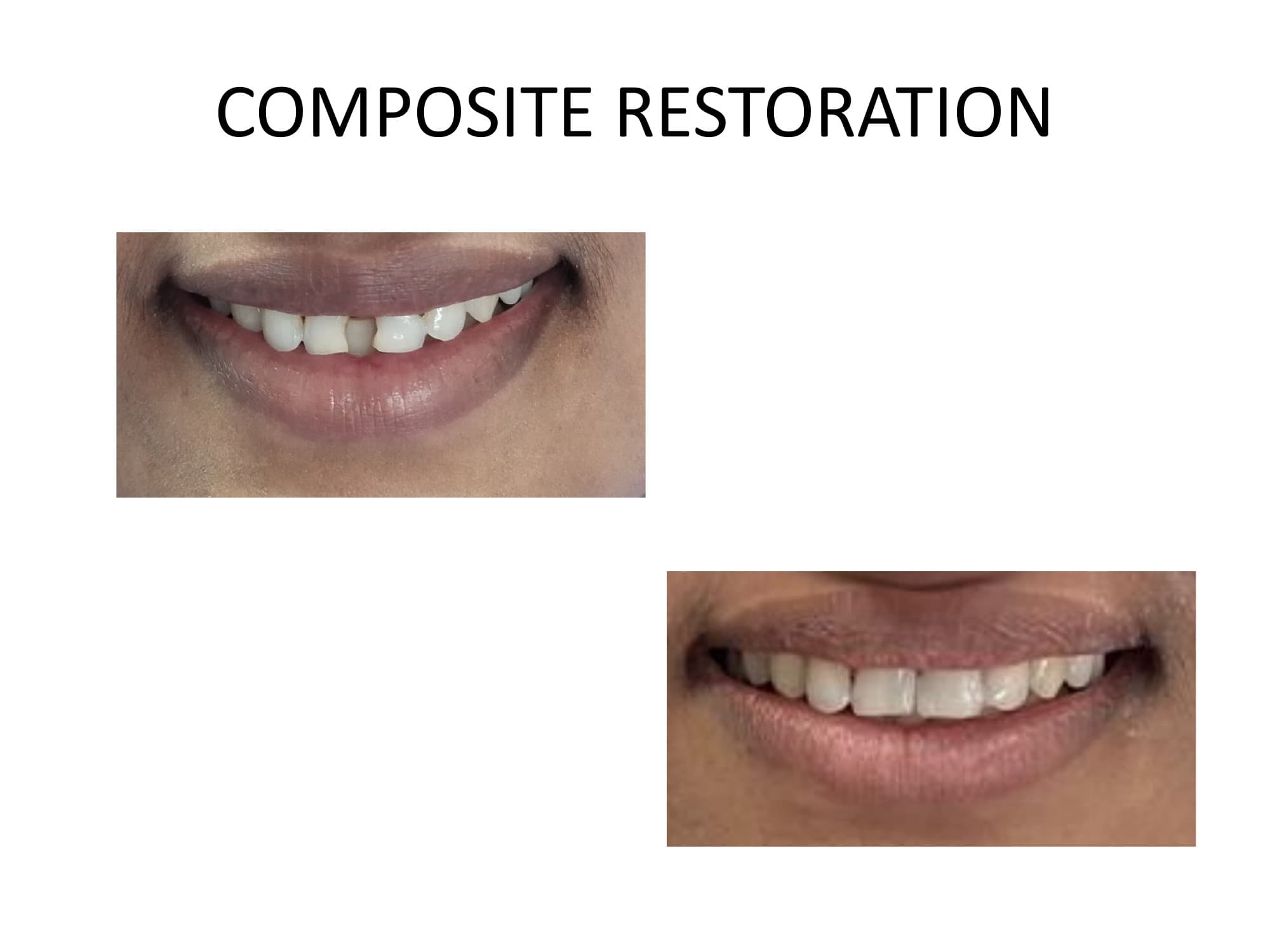 Composite restoration cases - aesthetic dental rehabilitation